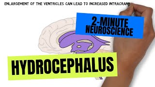 2-Minute Neuroscience: Hydrocephalus