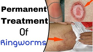 Permanent Treatment Of Ringworm ( Daad, khaj, kujhli )