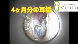 耳掃除動画vol.53「5回目の登場 4ヵ月分の耳垢」