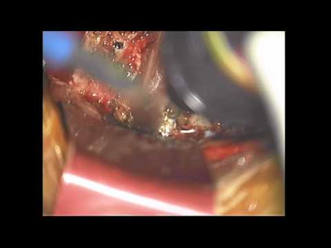 Anterior Foraminotomy in Cervical Region