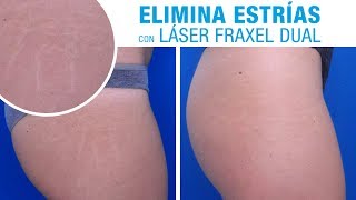 eliminar estrias laser barcelona