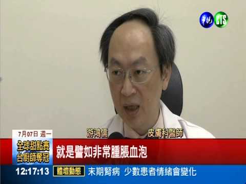 光腳踩沙扎傷 男爆蜂窩性組織炎