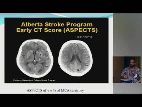A Practical Approach to the Managment of Ischemic Stroke   Rony Salem