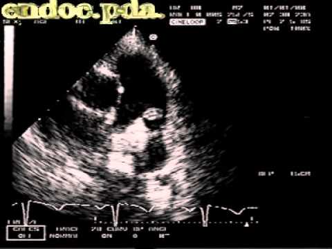 Infective Endocarditis On Patent Ductus Arteriosus (PDA)