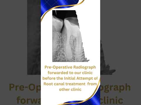 My Technique to treat calcified canals