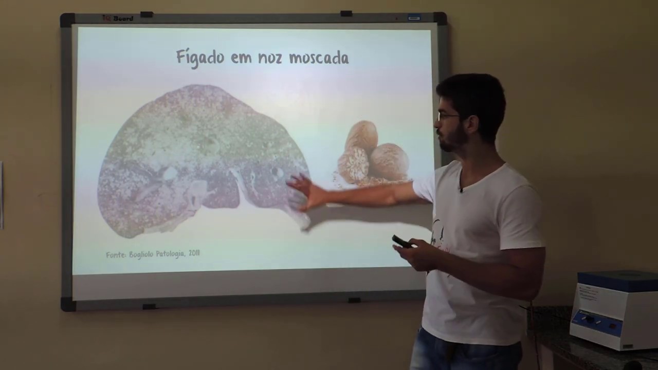 Insuficiência Cardíaca Congestiva - Precisa Desenhar?