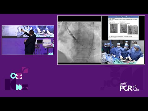 Optimisation of immediate and long-term outcomes using a novel self-expanding valve - GulfPCR-GIM