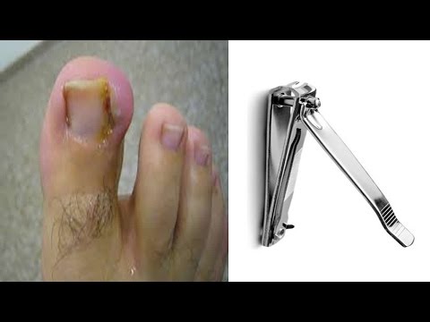 El precio en mikozan del hongo de las uñas en spb De que comenzar el tratamiento de la uña