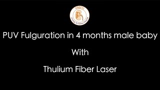 PUV Fulguration in 4 months male baby With Thulium Fiber Laser (TFL)