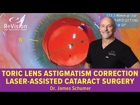 Toric IOL Cataract Surgery