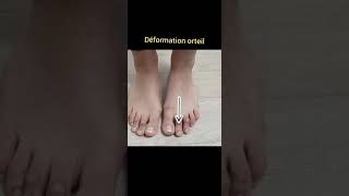 chirurgie du pied #avantaprès #shorts #halluxvalgus #halluxvalgusoperation #pieds #metatarsalgies