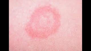 How to Treat Ringworm in Children