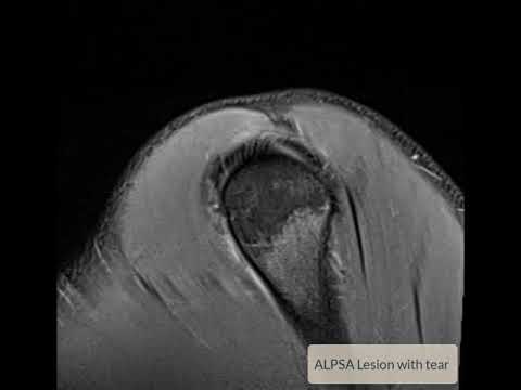 ALPSA lesion with tear.