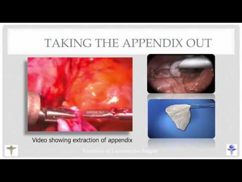 Master Class on Laparoscopic Appendicectomy