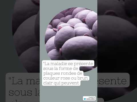 Vidéo : pityriasis versicolor — causes, symptômes et traitement