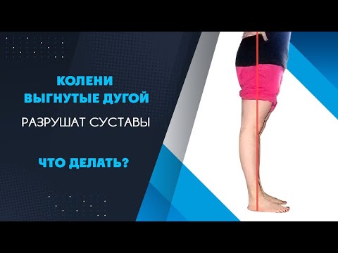 Что делать при рекурвации коленей? Колени выгибаются назад. Опасно ли это?