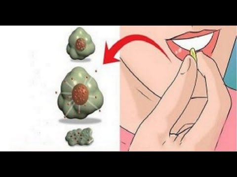 Gutartiger Prostata-Hyperplasie Harnanalyse Zirbenbad von Prostatitis