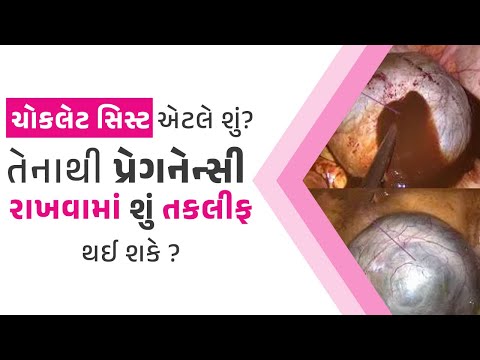 ચોકલેટ સિસ્ટ એટલે શું? તેનાથી પ્રેગનેન્સી રાખવામાં શું તકલીફ થઈ શકે? Chocolate cyst&Endometriosis