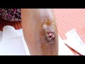 Abscess Drain,Medical Relief Trip, Cambodia. for educational purposes
