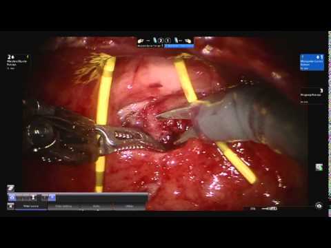 Robot Assisted Laparoscopic Transvesical Repair Of Rectovesical Fistula
