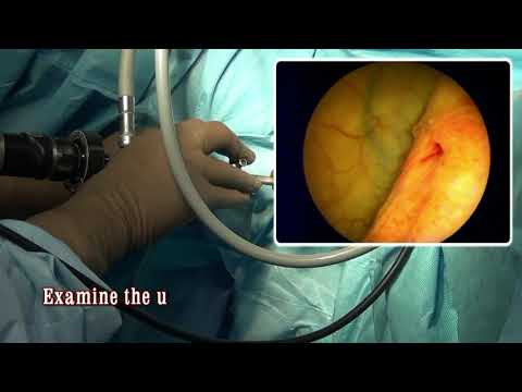 Extracción de stent en hombres