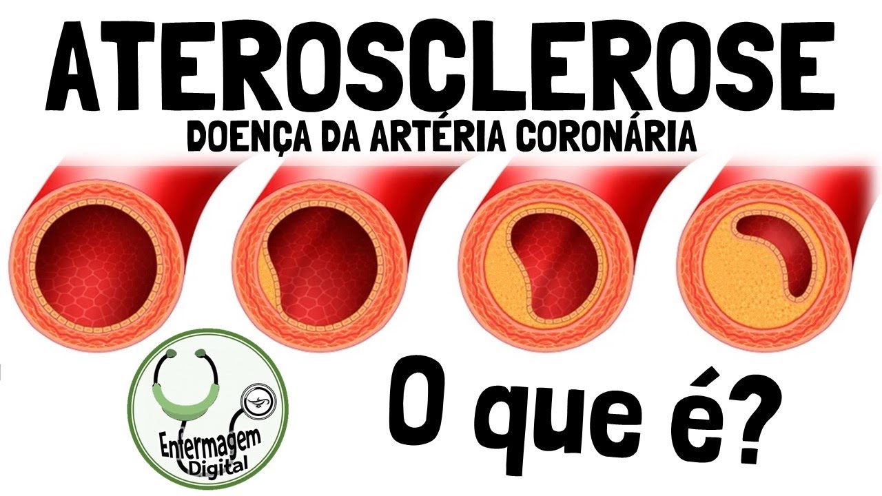 ATEROSCLEROSE - DOENÇA DA ARTÉRIA CORONÁRIA