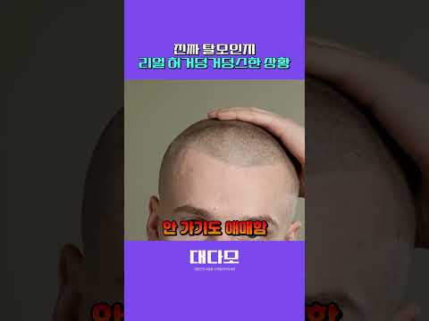 我也有脱发基因吗？？？？？？