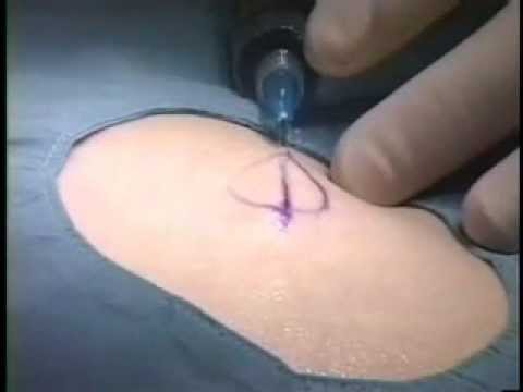 comment traiter un lipome