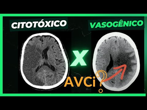 Como  diferenciar o Edema Citotóxico do Edema Vasogênico na TC de crânio