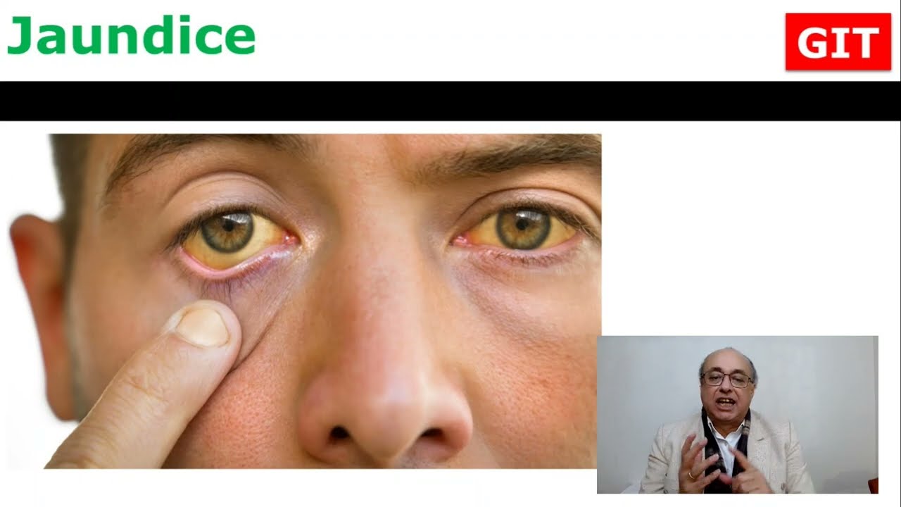 Jaundice (Gastroenterology GIT)