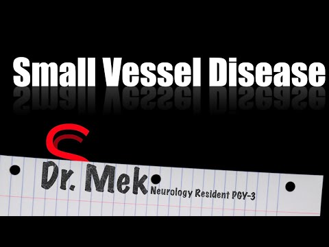 Strike Stroke with Dr. Mekdes: Lacunar stroke / small vessle disease (E10)