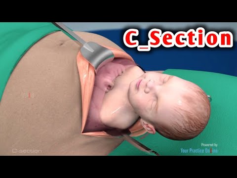 شاهد الولادة الطبيعية والولادة القيصرية وحدد ايهما افضل watch caesarean section and natural birth