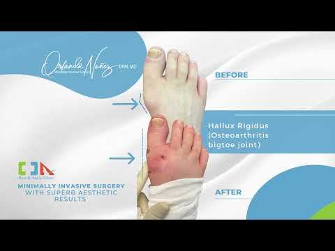 Hallux Rigidus (Osteoarthritis bigtoe joint)
