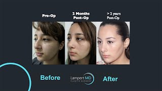 Lampert Md Plastic Surgery