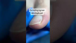 Download lagu Pain-free ingrown nail fix 🦶 #nailtech #onyfix #toenails mp3