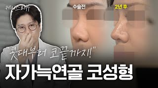 “둥글고 큰 복코, 이렇게 바뀌었어요” 자가늑연골로 슬림한 코라인 완성 | 외국인 여성 코성형 케이스리뷰