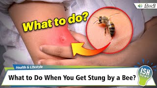 What to Do When You Get Stung by a Bee?