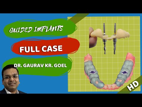 How are Dental Implants Done? Guided Dental Implants: Full Clinical Procedure in HD@drgkg