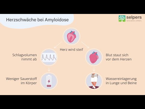 Amyloidose und das Herz: die kardiale Amyloidose (Experte informiert)
