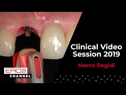NO screw, no glue the prosthodontist's dream comes true