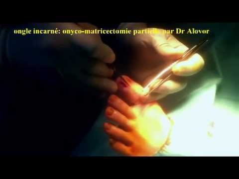 comment guerir ongle incarné