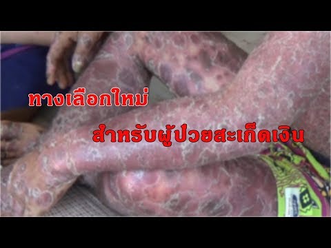 ที่ดีกว่าในการรักษาโรคสะเก็ดเงินที่เล็บ Gioksizonovaya ครีมสำหรับโรคสะเก็ดเงิน