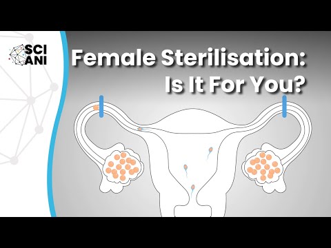 Female sterilisation: Is it for you?