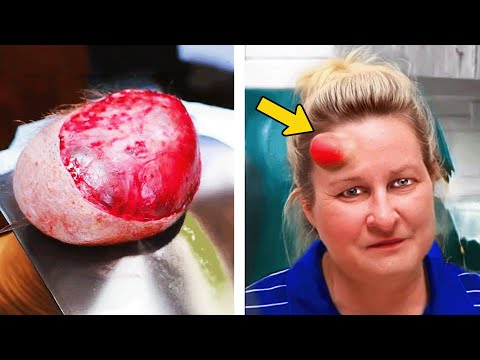 Frau hat 20 Jahre einen riesigen Knoten am Kopf. Bei der Entfernung wird Erschreckendes entdeckt!