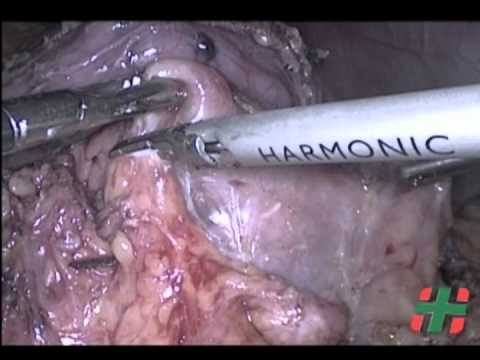 Laparoskopowa rewizja jamy brzusznej z powodu przetoki żołądkowej po zabiegu by-pass żołądka