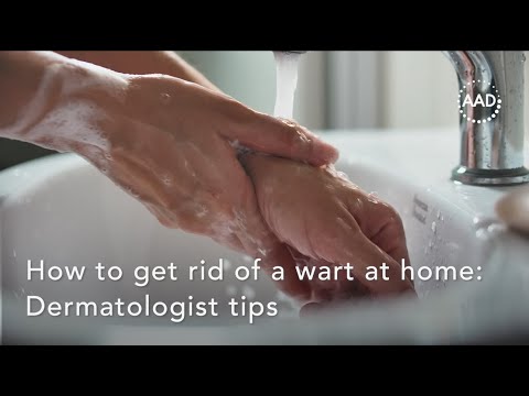 How to get rid of a wart at home: Dermatologist tips