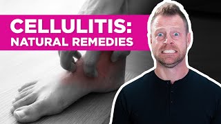 Are There Natural Remedies for Cellulitis?