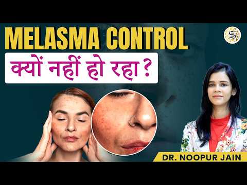 Melasma क्यों बढ़ता है? Melasma को Control करने का सबसे आसान तरीका | Skinzest