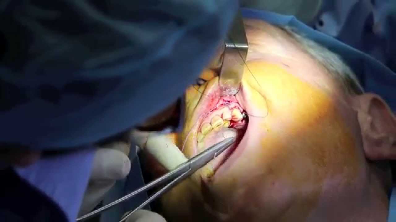 Watch video Pose d'implants - Dr Pierre SULTAN - Dentiste 92 Pose d'implants - Dr Pierre SULTAN - Dentiste 92