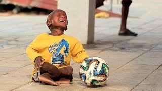 Rarest skin disease Harlequin Ichthyosis turning the boy slowly into STONE